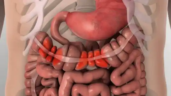 Estos son 6 síntomas de cáncer de colon que debes conocer