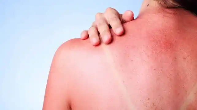 La insolación, las quemaduras y el dolor de cabeza pueden aparecer post exposición al sol