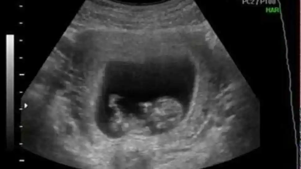 Terror por una ecografía que muestra una "beba diabólica que sonríe"