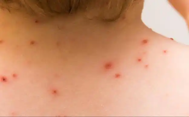 Viruela de mono: Advierten sobre la posibilidad de que surja un circuito local de contagios