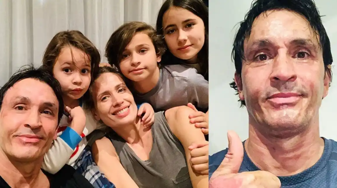 Sebastián Estevanez mostró cómo evoluciona su rostro, tras explotarle un bidón de alcohol