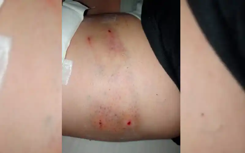 Un perro la mordió en Litoral 700: “El dueño me dijo que se le escapó, pero me dejó sola”