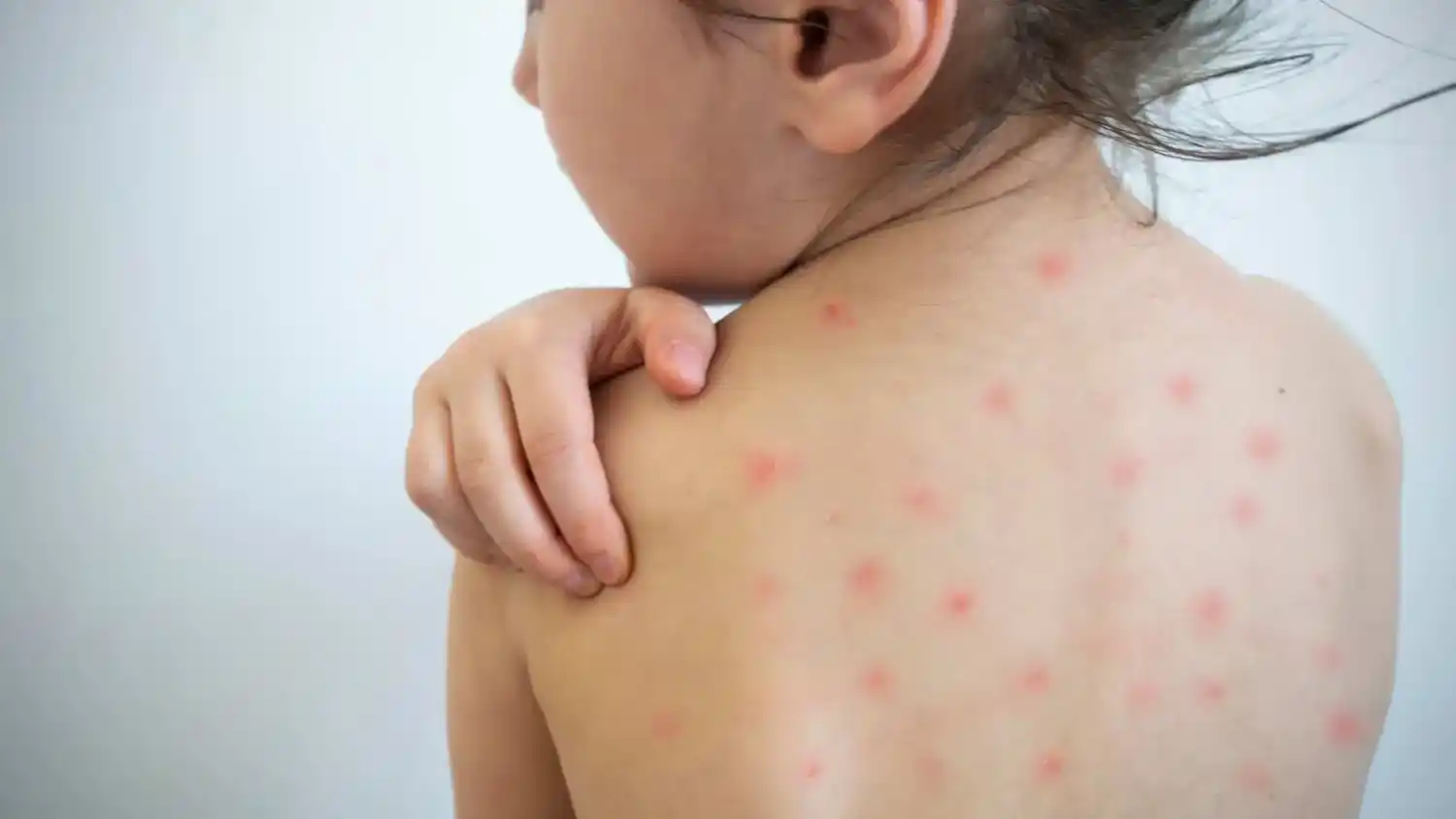 Se confirmó un caso de sarampión en un niño de 2 años que estuvo en Casilda
