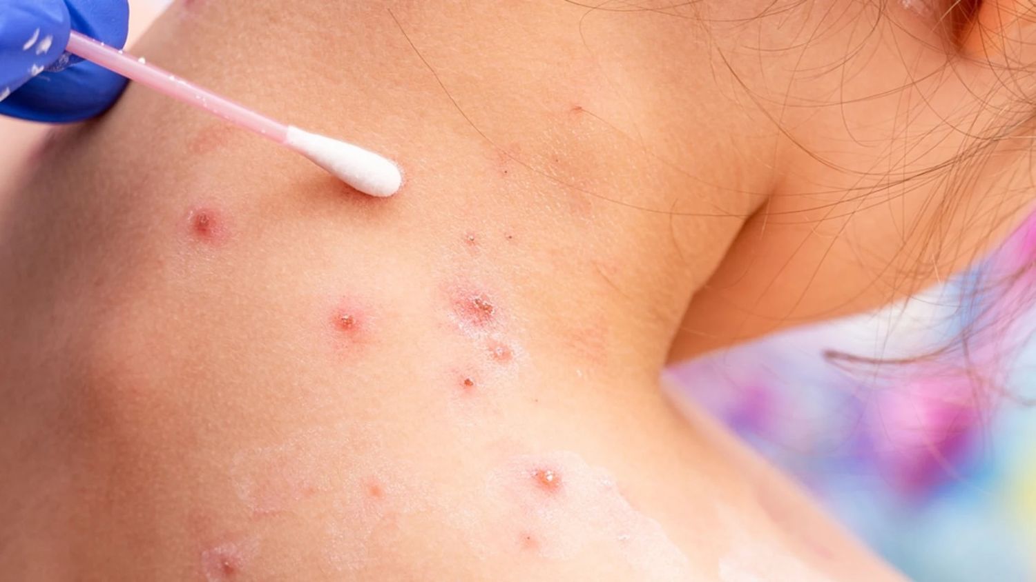 Viruela de mono: La OMS activa su máximo nivel de alerta sanitaria