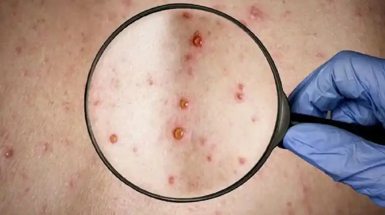 Brote de viruela del mono fuera de áreas endémicas