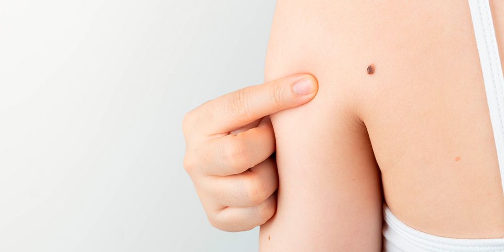 23 de mayo: Día Mundial contra el Melanoma