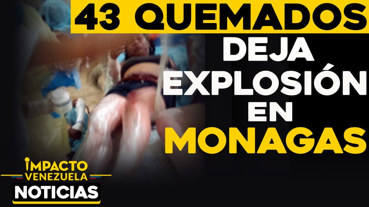 Seis con pronóstico reservado: siguen hospitalizadas 27 personas quemadas por explosión en Monagas