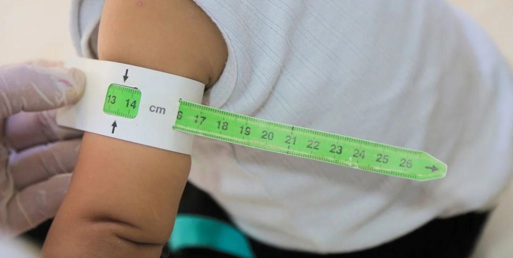 Fuerte incremento en las atenciones por desnutrición en niños y adolescentes