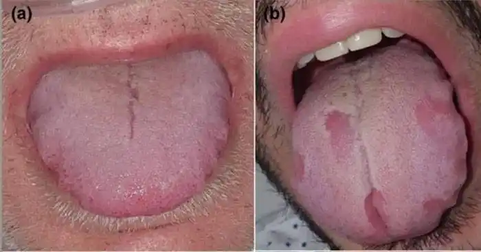 Confirman nuevos síntomas del covid: alteraciones en la lengua, manos y pies