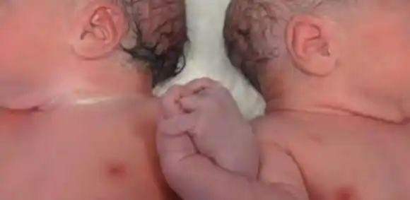 Mujer tuvo gemelos que nacieron en años distintos