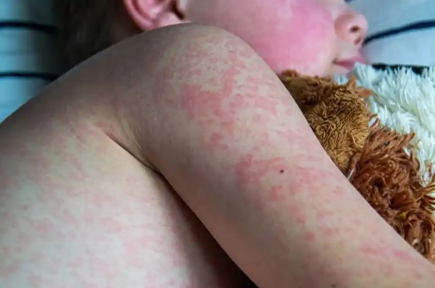 Suben los casos de sarampión: la vacunación es la única forma de cortar las cadenas de contagio