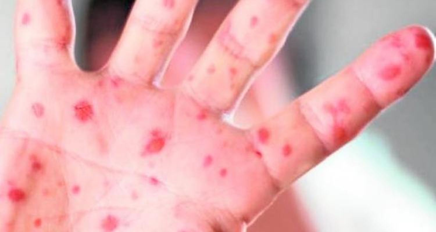 Vacunarán preventivamente contra el sarampión