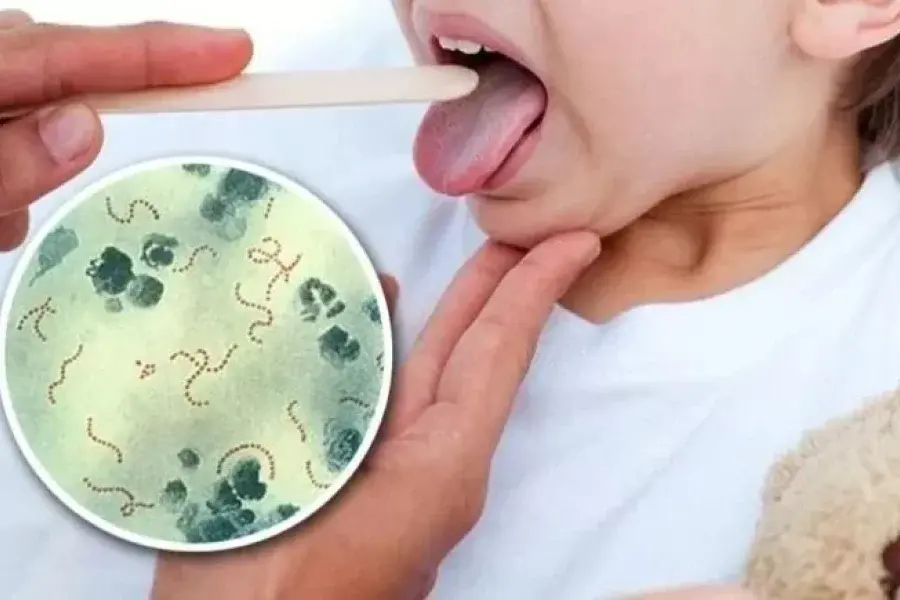 Preocupación por el streptococcus pyogenes: ya hubo 5 muertes en la zona de Rosario