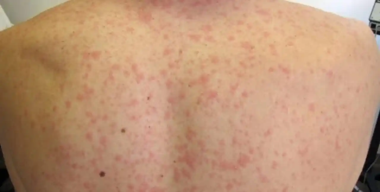 Paraguay: confirman el primer caso de sarampión en 25 años, cerca de la frontera argentina