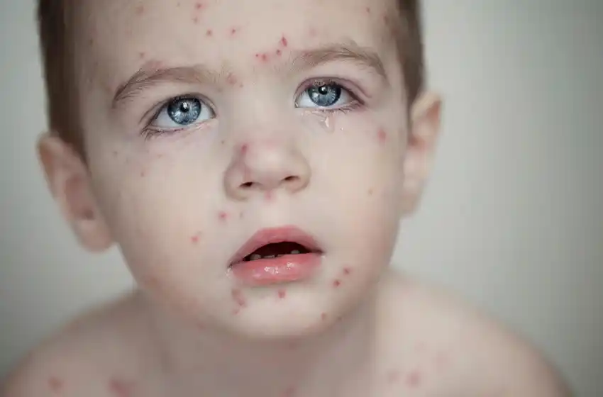 Más de 5.000 casos de sarampión por los movimientos antivacunas