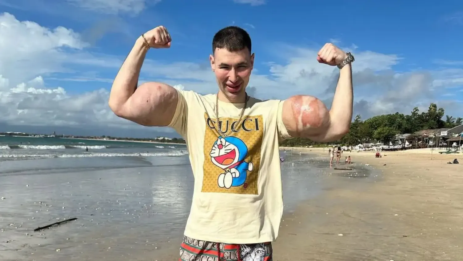 La obsesión del “Popeye ruso” por unos bíceps gigantes podría costarle los brazos si no mejora su salud