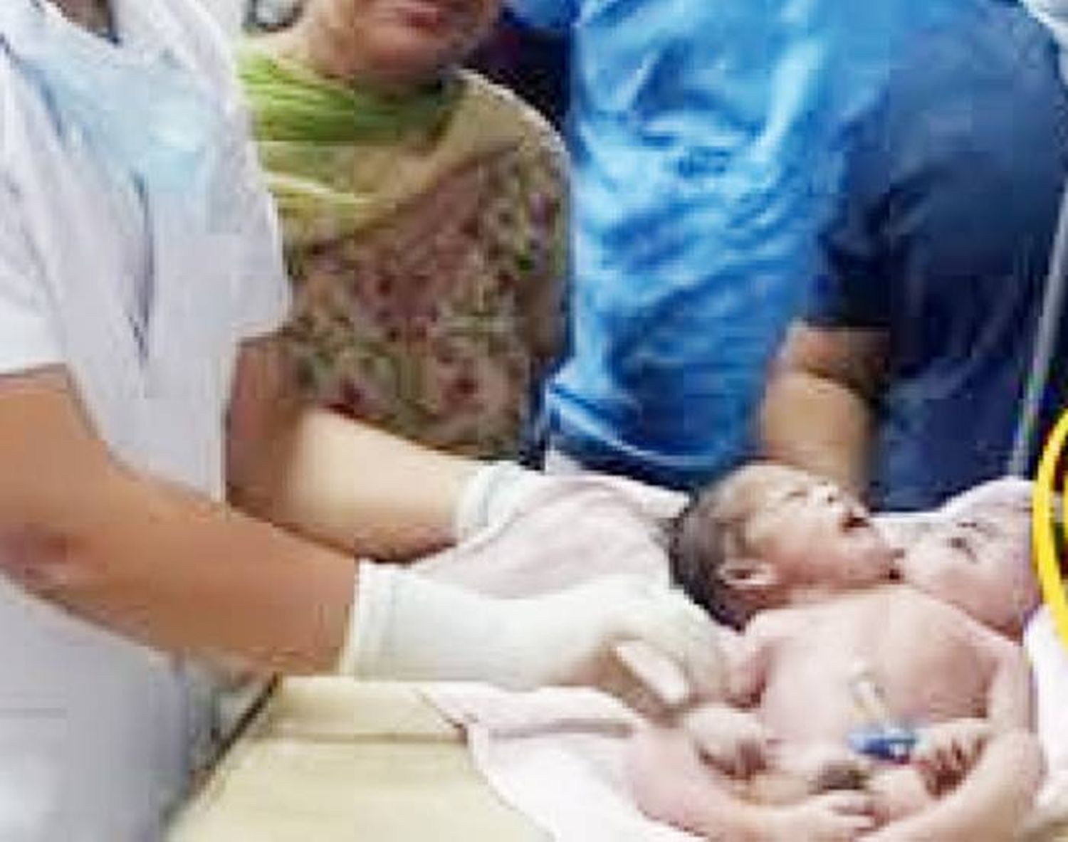 Increíble: un bebé nació con dos  cabezas y los médicos no se  dieron cuenta