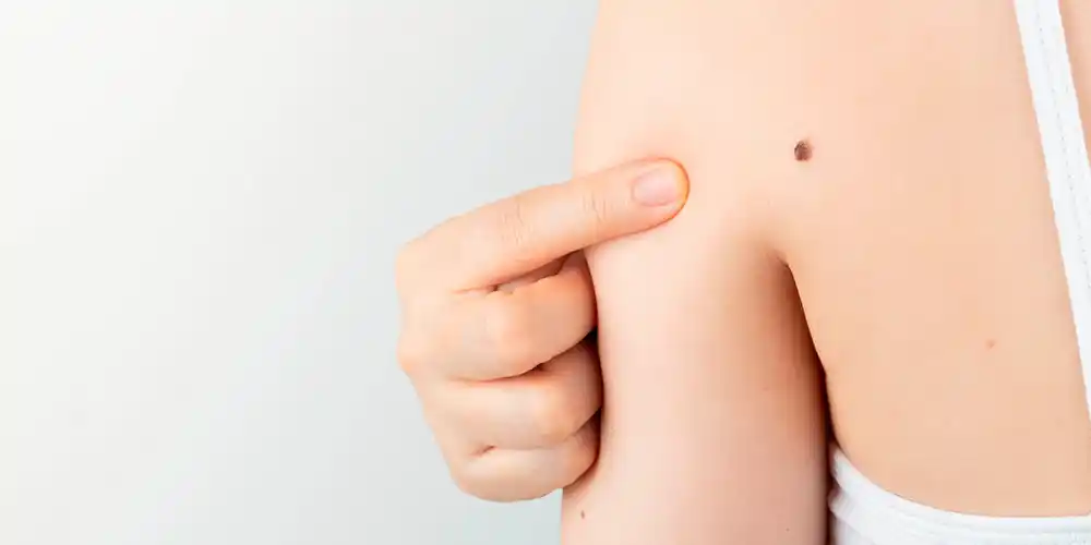 23 de mayo: Día Mundial contra el Melanoma