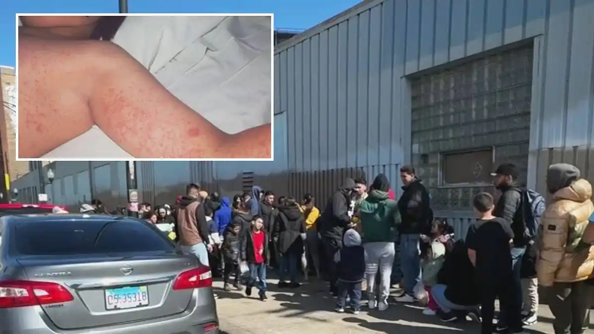 ¡PARA REMATAR! Brote de sarampión afecta albergue de migrantes en Chicago