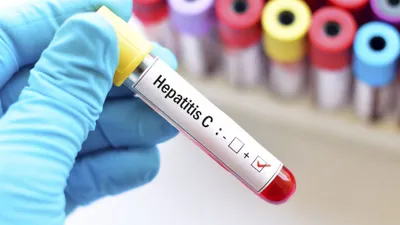 Hepatitis C, una enfermedad silenciosa que se puede curar