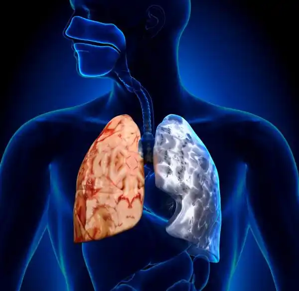 Hoy se celebra el Día Mundial de la EPOC