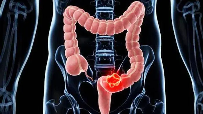 La dieta que reduce a la mitad el riesgo de cáncer de colon