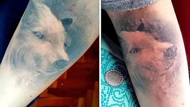 Detectan 67 casos de infecciones en la piel por hacerse tatuajes