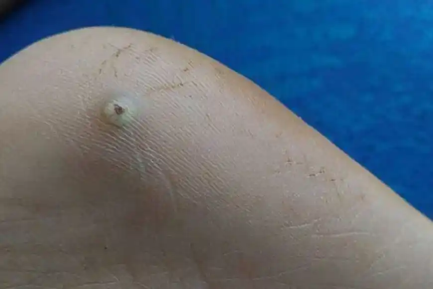 Conocido científicamente como Tunga penetrans,