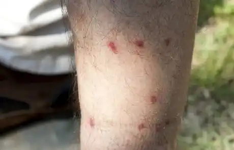 La mordedura de barigüí puede no ser dolorosa en principio pero rascarse complica la lesión.