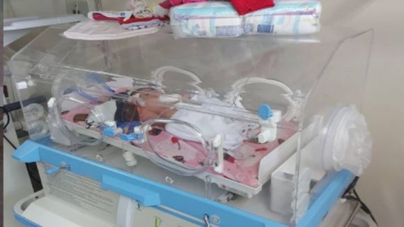 HICIERON TODO POR SALVARLAS: fallecieron siamesas que nacieron en Bolívar y compartían el corazón y el hígado