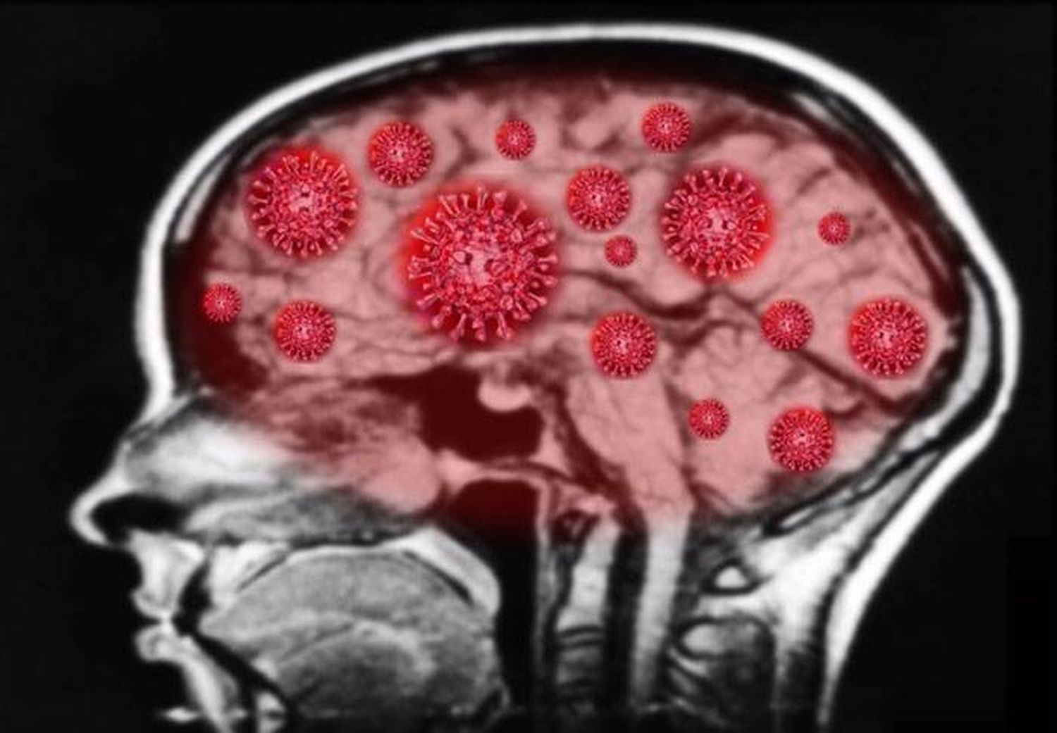 El coronavirus grave daña el cerebro de manera semejante al Alzhéimer