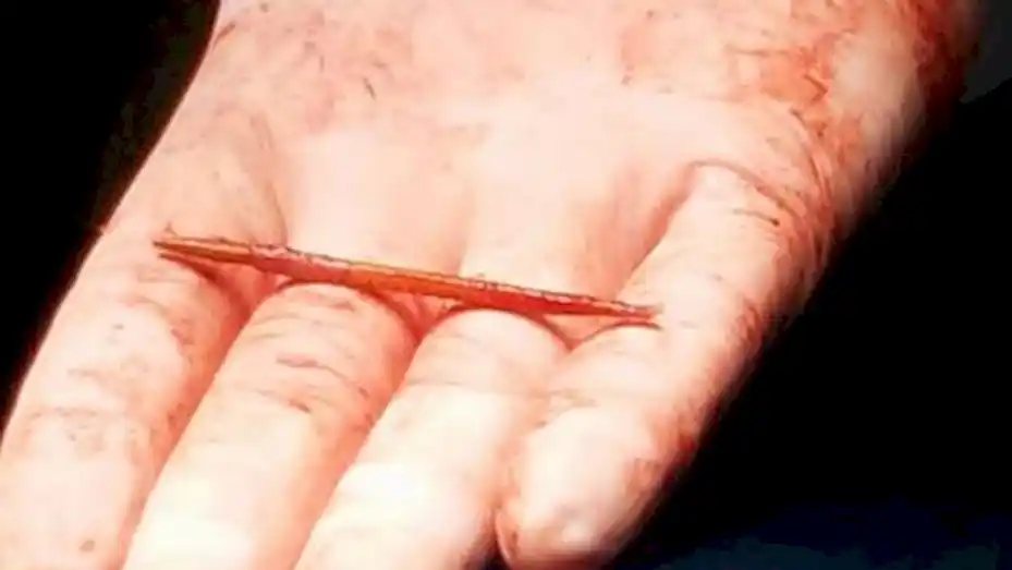 Insólito: le extraen un escarbadientes clavado en el corazón