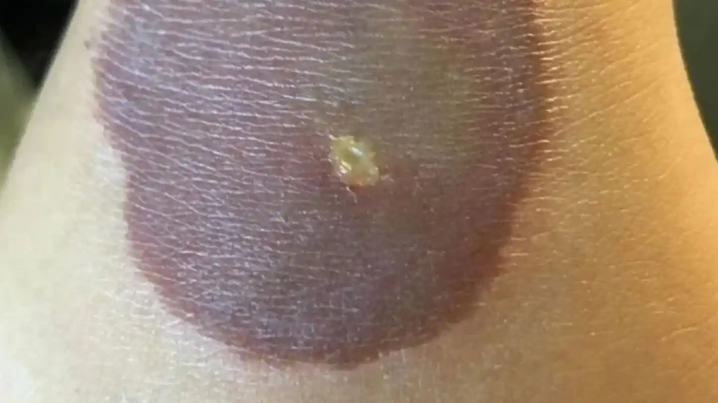 Una nena hizo un reto viral de TikTok, se arruinó el brazo y ahora deberá operarse