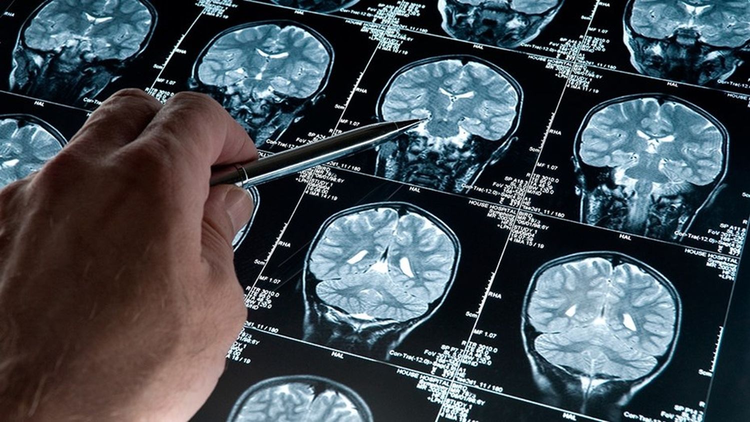 ¿Cuál es el fármaco que retrasa el  Alzheimer y se aprobó en Estados Unidos?