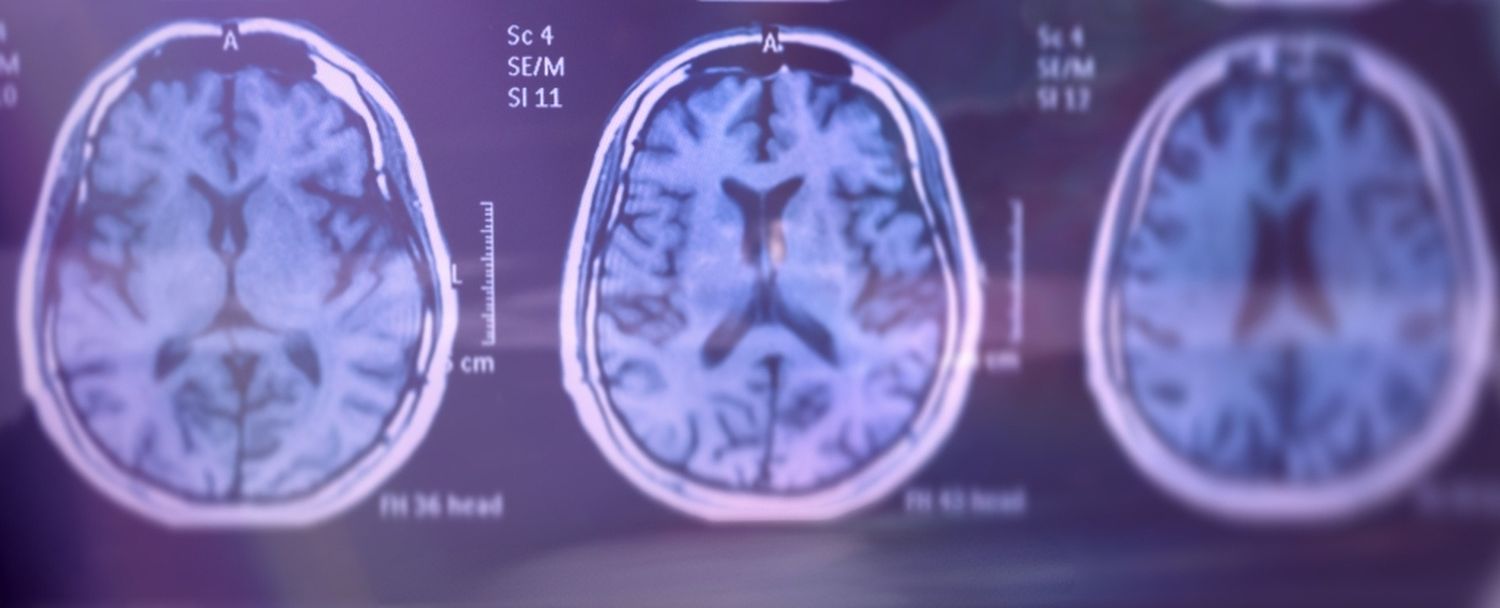 Brain Scan Image for Alzheimer Tests