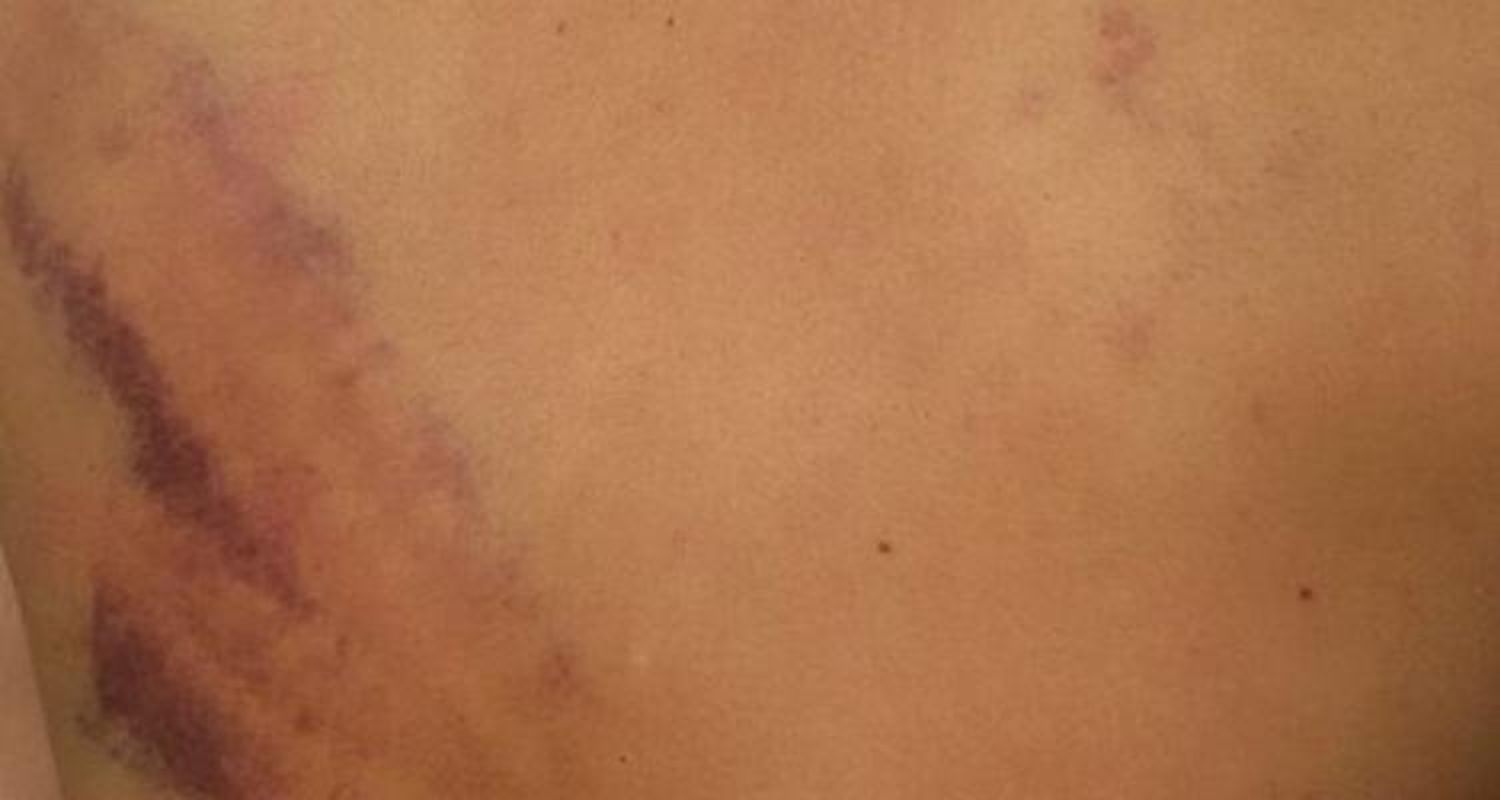 Joven de Río Tala denunció haber sido golpeado por policías