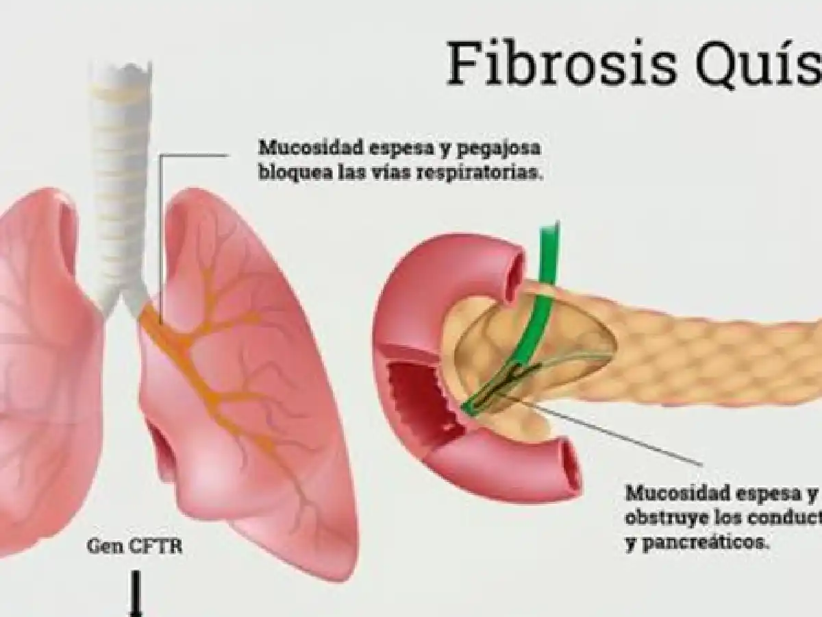 Argentina aprobó la primera terapia específica para tratar la Fibrosis Quística 