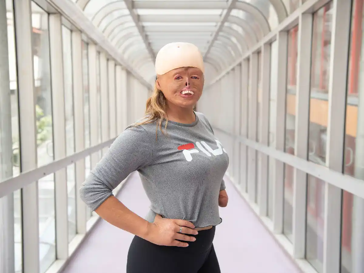 Brisa: a los 7 meses se quemó el 90% de su cuerpo y hoy es deportista y modelo