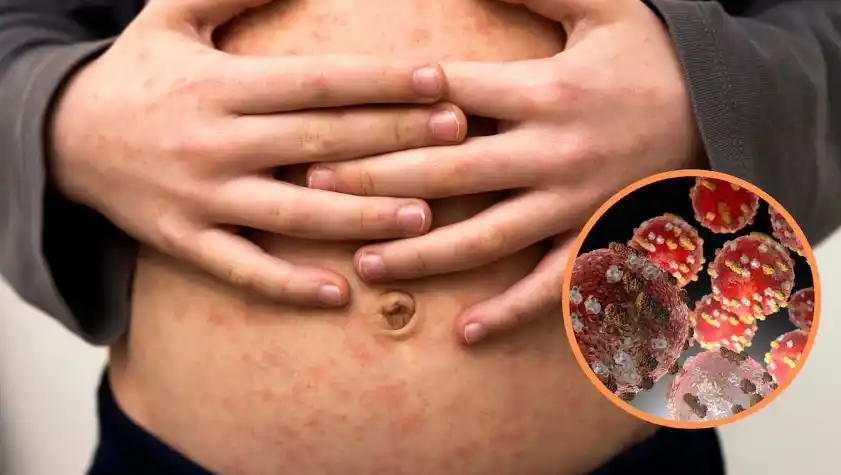 El sarampión, una de las infecciones virales más contagiosas, fue eliminado en Argentina en el año 2000.