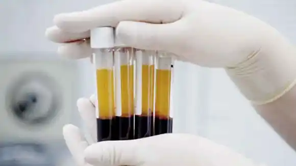 Plasma de sobrevivientes del COVID-19 redujo muertes de pacientes un 57%