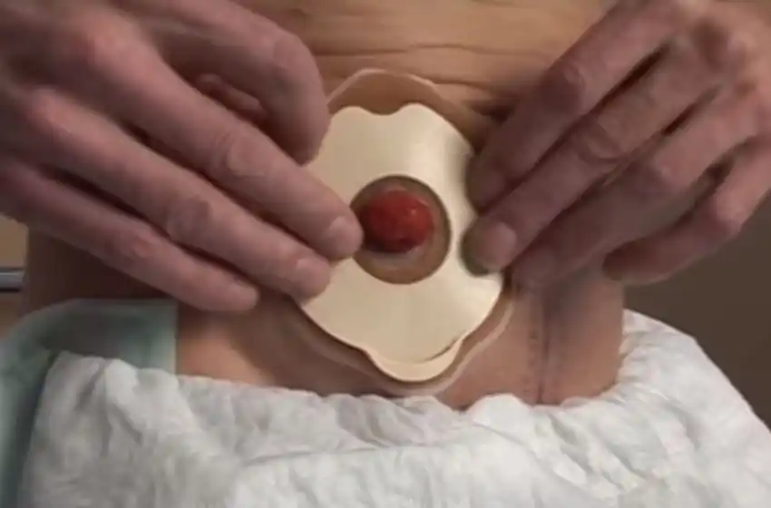 Discutió con policías y les tiró con una bolsa de colostomía