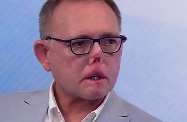 El hombre que perdió las piernas, los dedos y parte de la cara por su perro