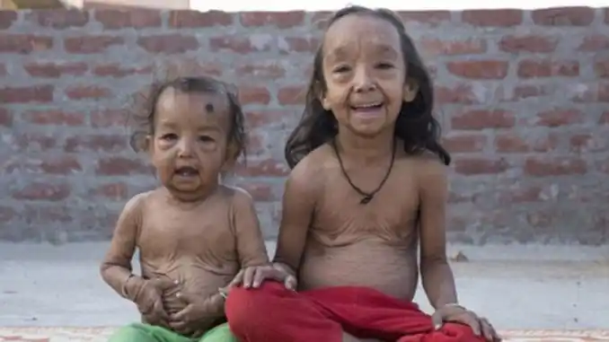 Las fotos de los niños con la "enfermedad de Benjamin Button"