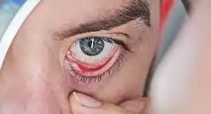 ATERRADOR HONGO NEGRO ataca a pacientes con coronavirus. ¿Qué es?