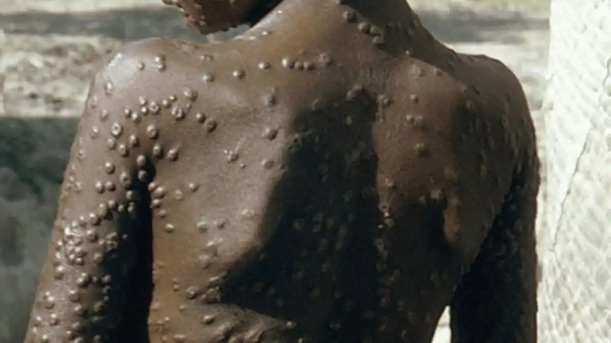 VIRUELA DEL MONO MATA A 548 en el Congo y Suecia reporta un primer caso