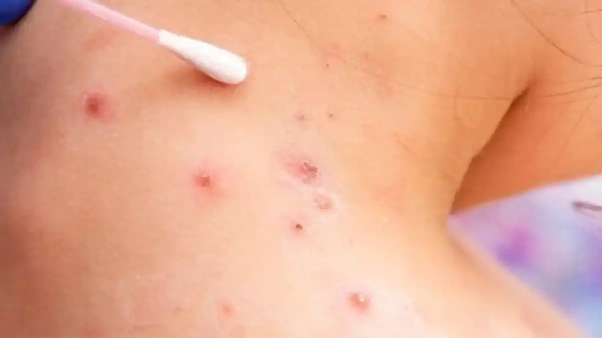 Viruela del mono: “Hasta el momento, los contactos del caso positivo no presentan síntomas”