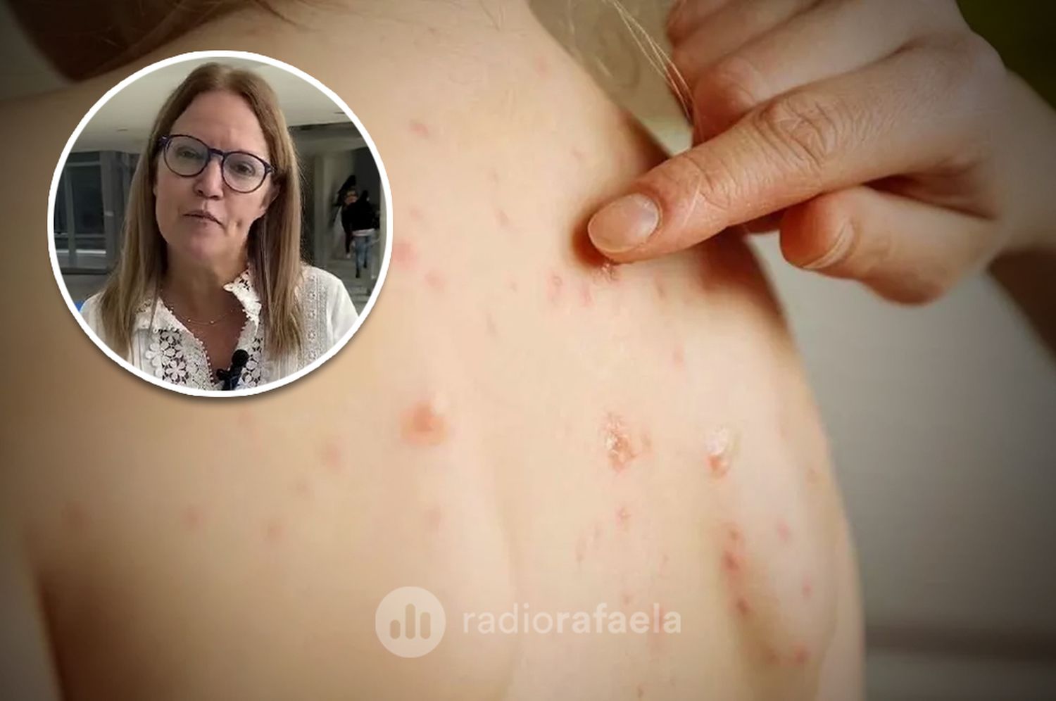 Santa Fe en alerta por inminentes brotes de sarampión: "Es muy importante verificar el carnet de vacunación"