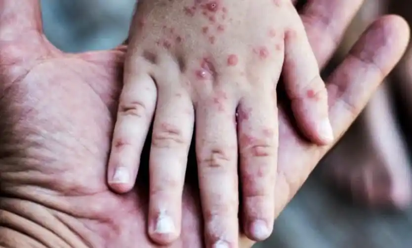 Sarampión en el AMBA: el brote sumó un nuevo caso y hay 500 personas en vigilancia