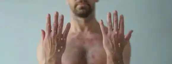 Suecia reportó el primer caso de una cepa mortal de viruela del mono fuera de África