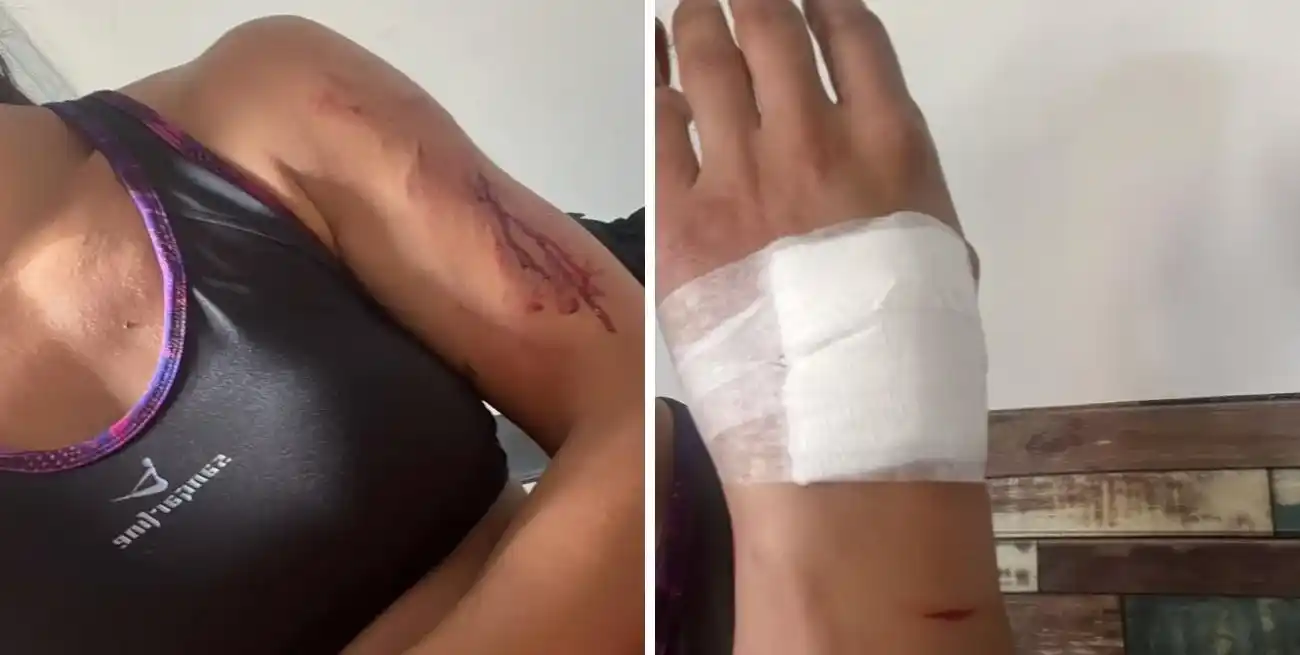 Una mujer fue brutalmente atacada por un perro Pitbull y terminó en el hospital de San José del Rincón